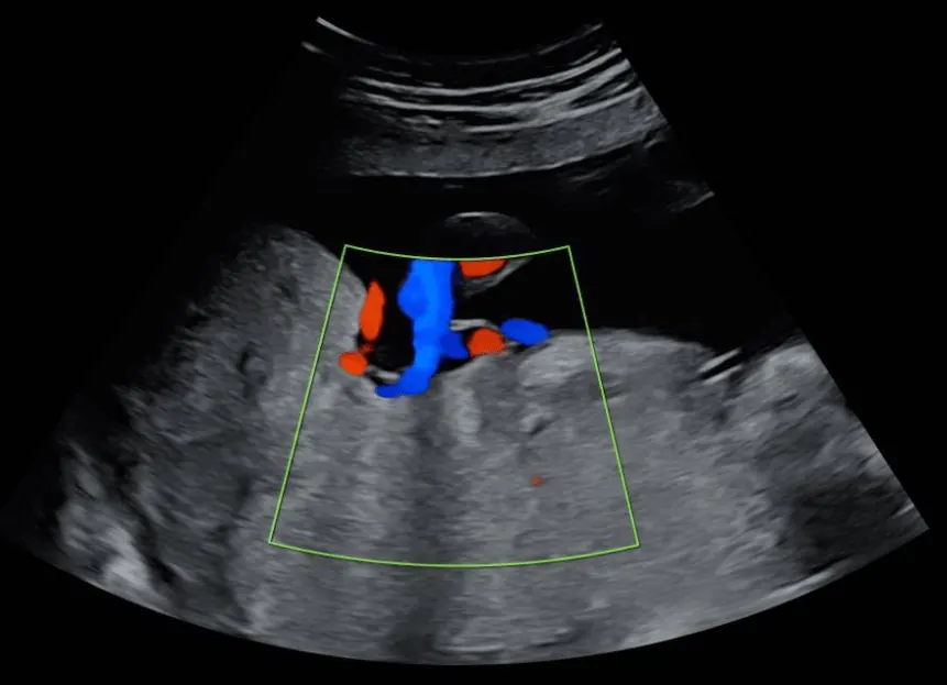 Ultrassom obstétrico e ultrassom com Doppler na gestação: o que é e qual a diferença?